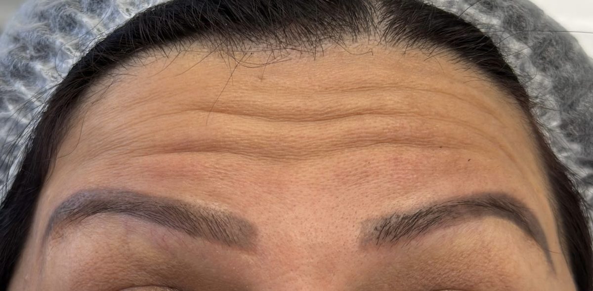 Before botulinum therapy