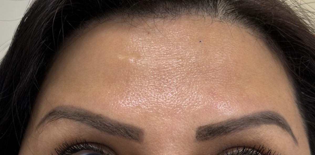 After botulinum therapy