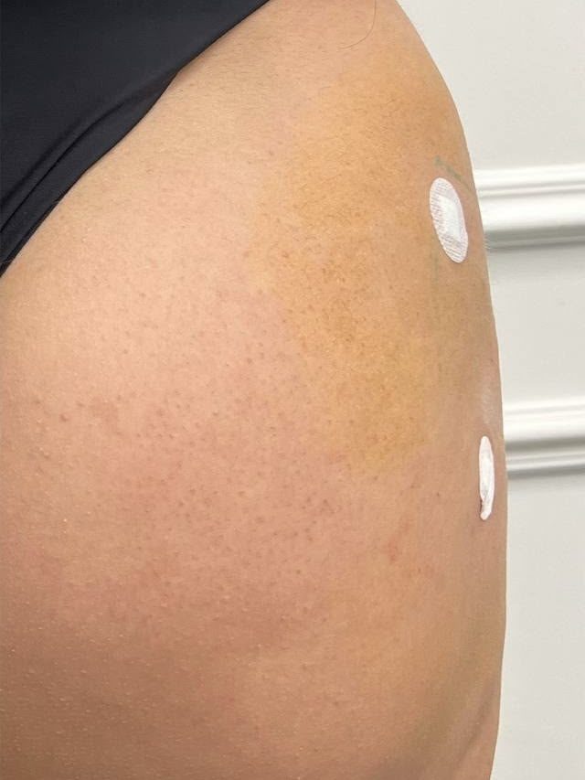 After body filler