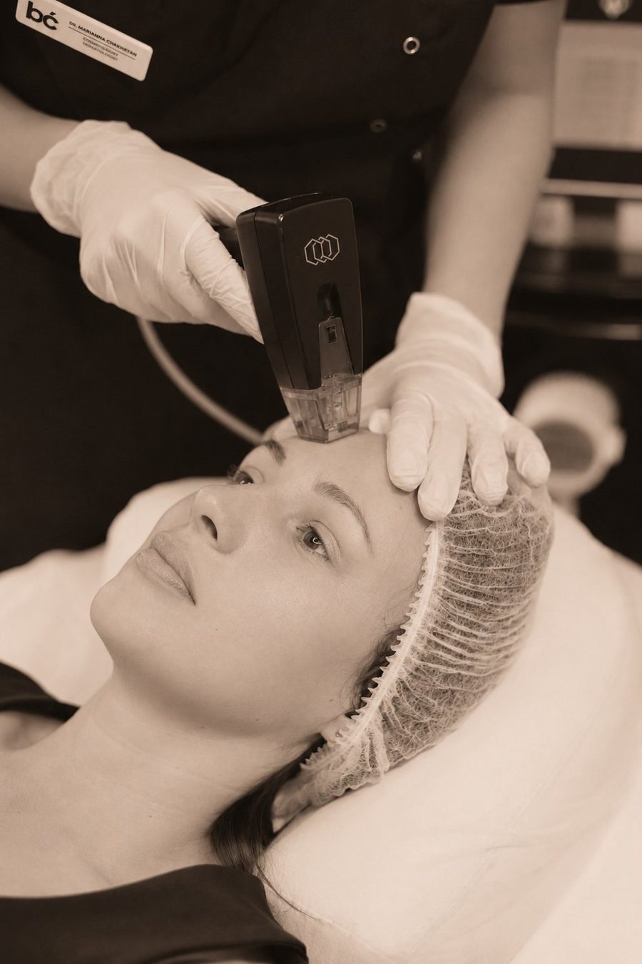 Morpheus8 RF microneedling treatment