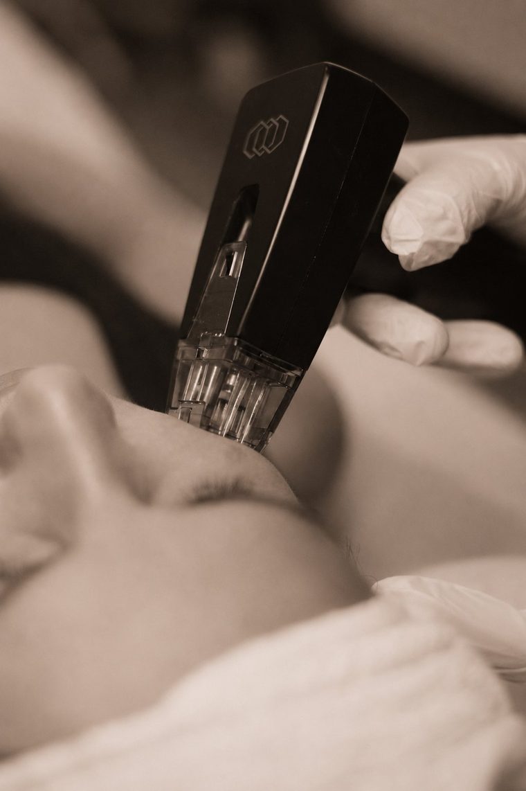 Morpheus8 handpiece close-up