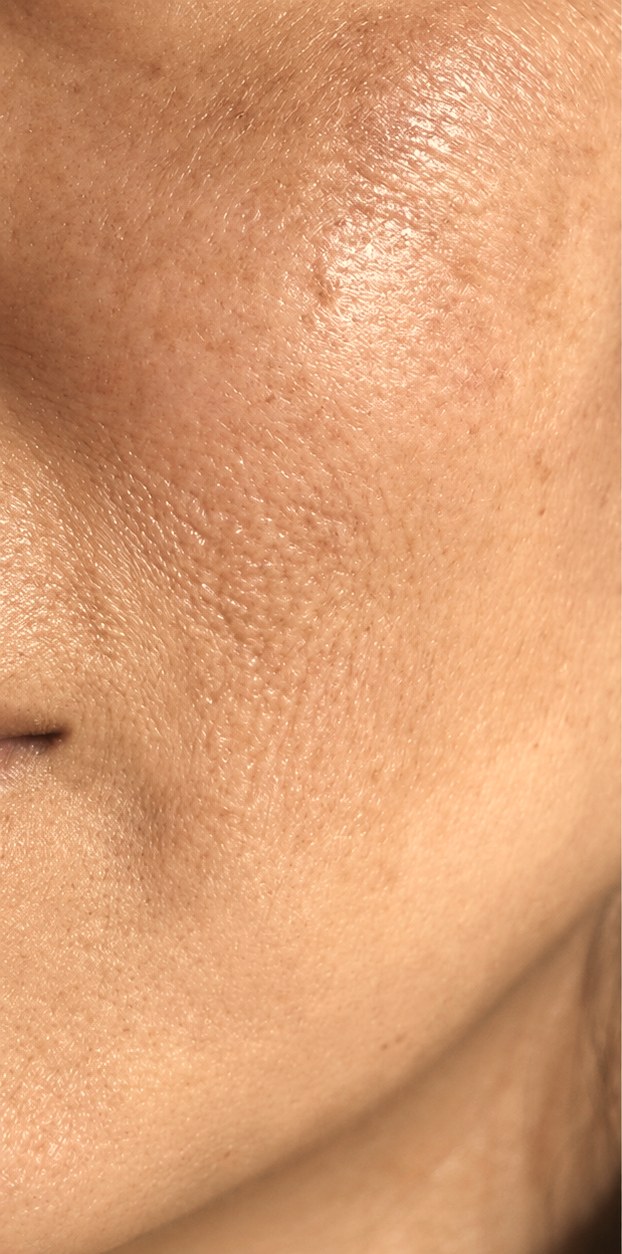 Pigmentation before