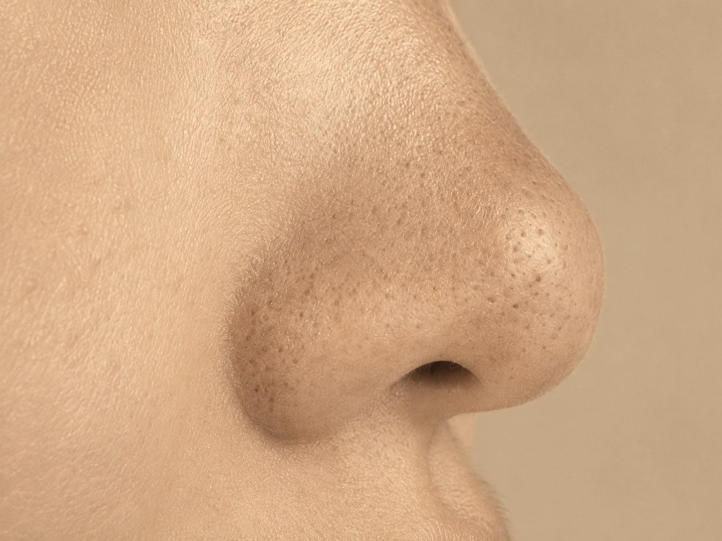 Enlarged pores before