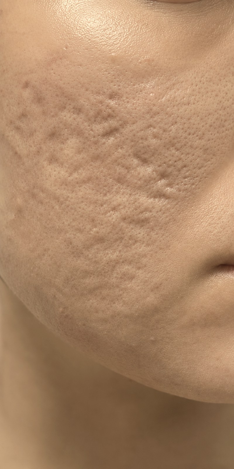 Post-acne scars before